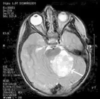 migraine brain mri