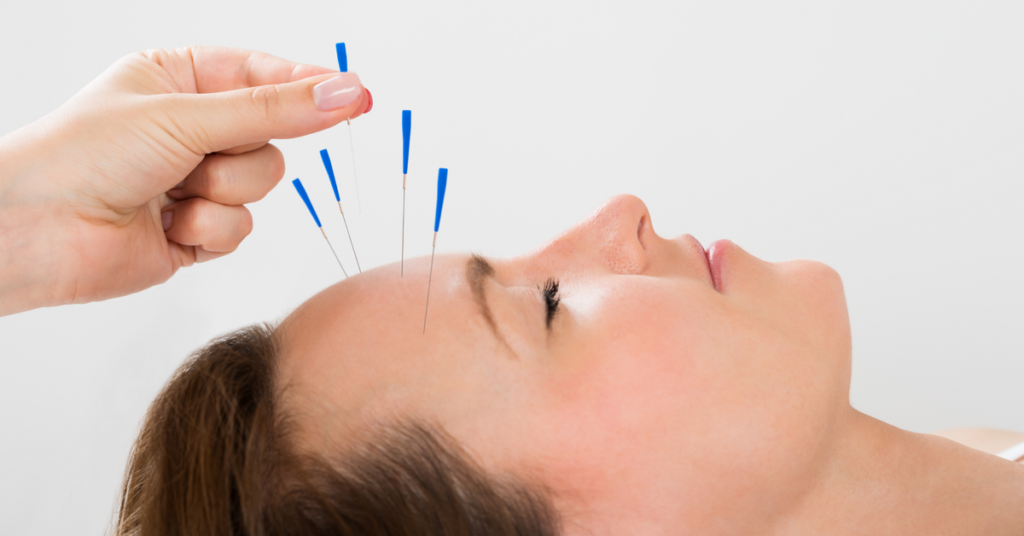 Acupuncture and Migraine: Finding a combination that sticks