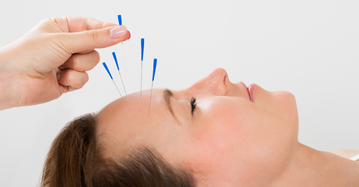 Acupuncture